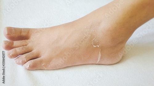 Skin condition where skin at foot and fingers starts peeling off indication mostly vial, fungal or bacterial infection, allergic reaction or deep medical condition