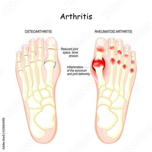 osteoarthritis, rheumatoid arthritis, and posttraumatic arthritis.