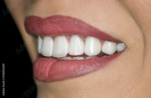 Hollywood smile