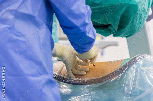 Surgeon in blue surgical gown uniform doing lumbar puncture before insert epidural catheter under fluoroscope inside modern operating room. Epidural steroid injection use for spinal stenosis patient. photo