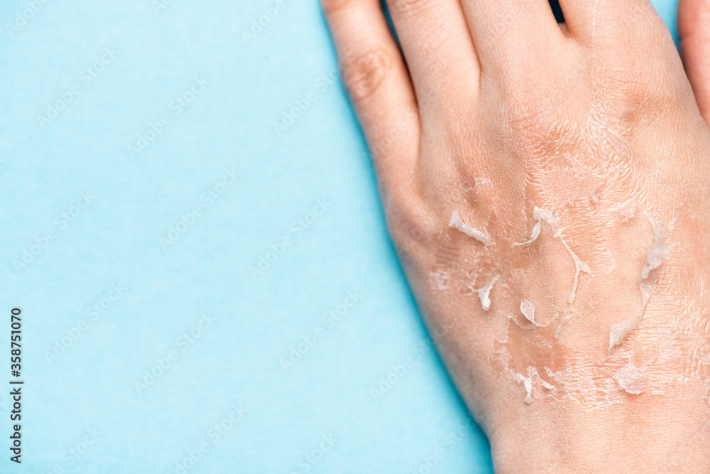 Fototapeta premium partial view of female hand with dehydrated, exfoliated skin on blue