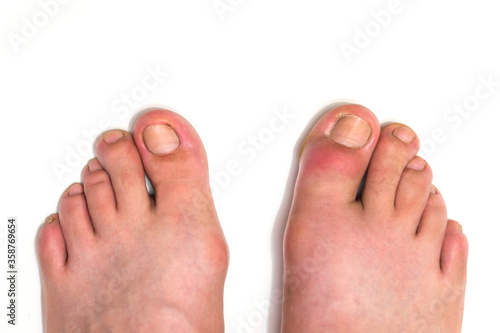 Gout or podagra on the big toe appears as redness and a unbearable pain photo