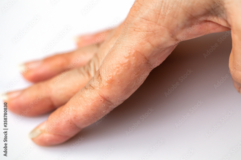 Close up Atopic dermatitis on finger(AD), also known as Atopic eczema.Skin disease concept. Close up Atopic dermatitis on finger(AD), also known as Atopic eczema.Skin disease concept.