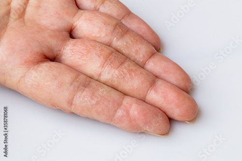 Close up Atopic dermatitis on finger(AD), also known as Atopic eczema.Skin disease concept.