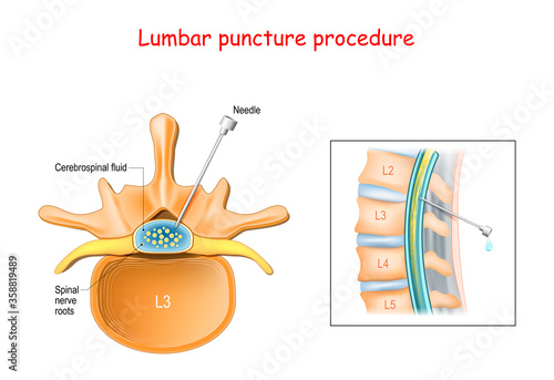 Lumbar puncture procedure.