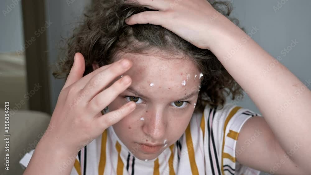 Teenage girl lubricates acne with some kind of cream. The danger of self-medication. Teenage girl lubricates acne with some kind of cream. The danger of self-medication.