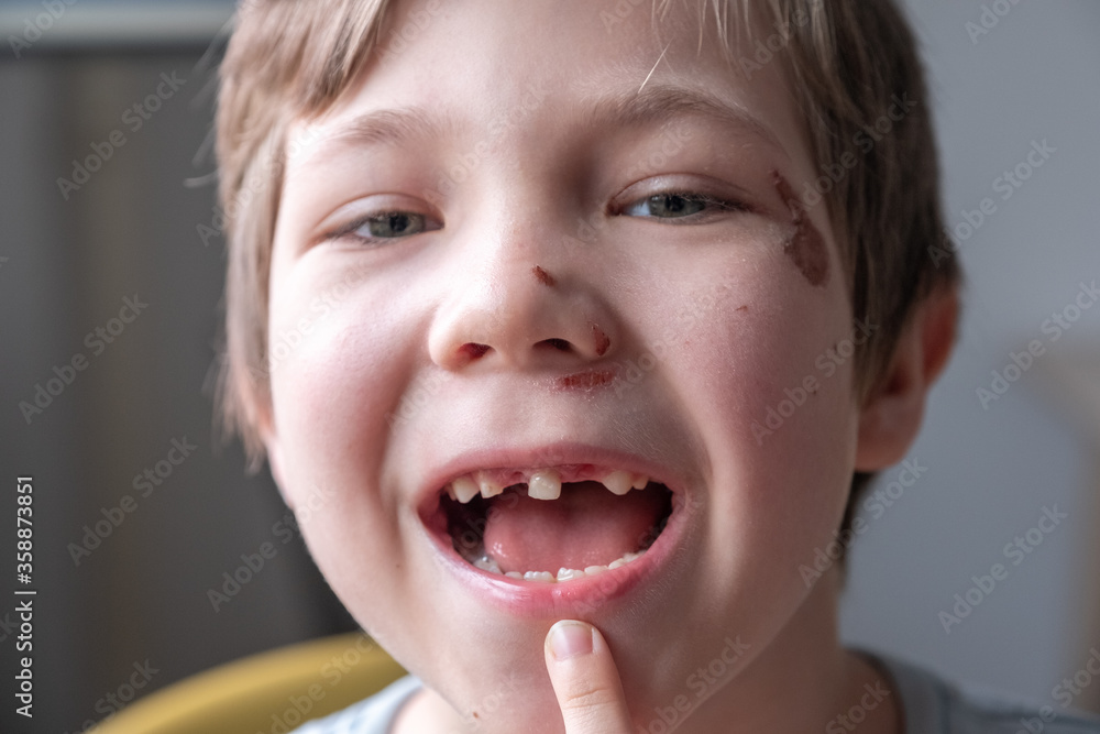 Toothless kid smiling. Little boy Show Broken teeth Toothless kid smiling. Little boy Show Broken teeth