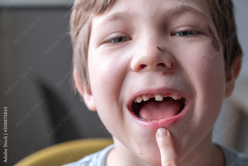 Toothless kid smiling. Little boy Show Broken teeth Toothless kid smiling. Little boy Show Broken teeth
