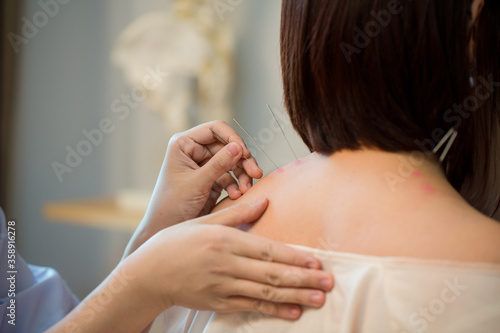 Bilde på lerret Acupuncture.Close-up Of A Person Getting An Acupuncture Treatment
