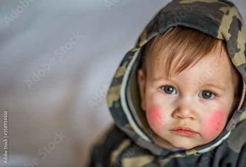 Atopic dermatitis eczema in baby.Condition that causes the skin to become red,dry,sore,itchy and cracked.Atopic eczema most often affects face in children.