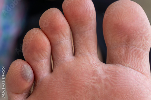 Close-up of man's foot finger with a large blister on the inside of the foot