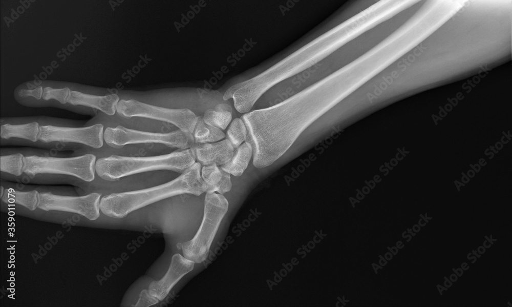 Naklejka premium radiograph of the wrist joint and hand of an adult