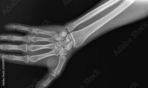 radiograph of the wrist joint and hand of an adult