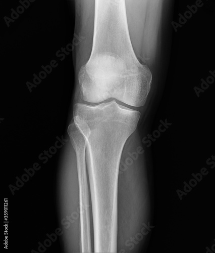 x-ray of the knee joint of an adult in a direct projection