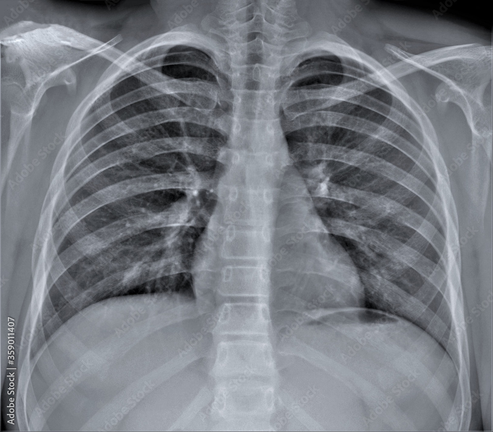 radiography of the chest.diagnosis of lung diseases.pneumonia radiography of the chest.diagnosis of lung diseases.pneumonia
