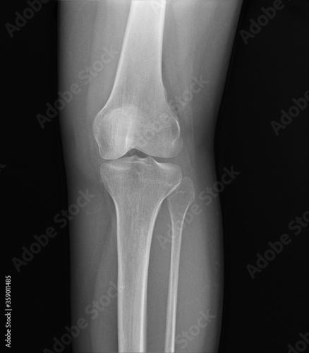 x-ray of the normal knee joint.medical diagnostics