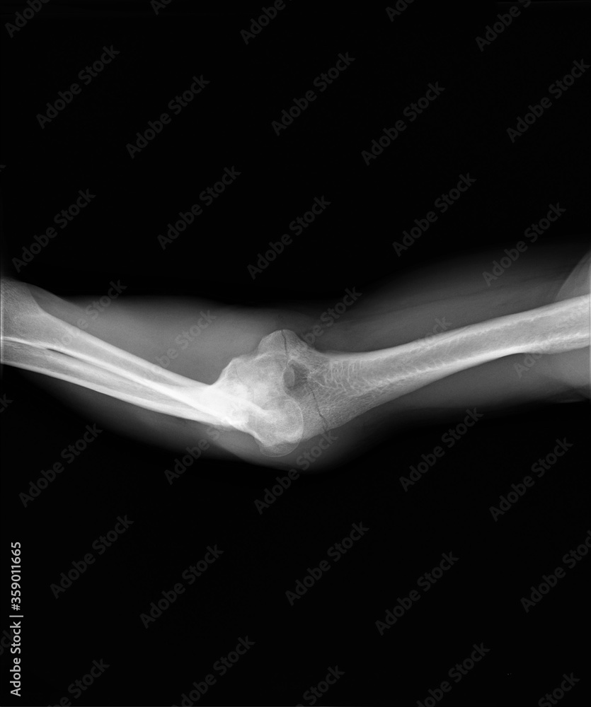 Obraz premium radiograph of the elbow joint of an adult with a fracture of the condyles of the humerus