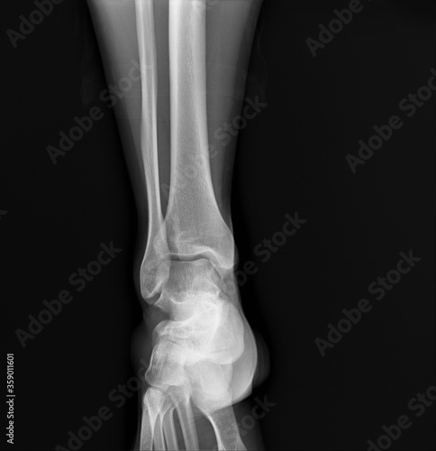 the x-ray shows an adult s ankle joint
