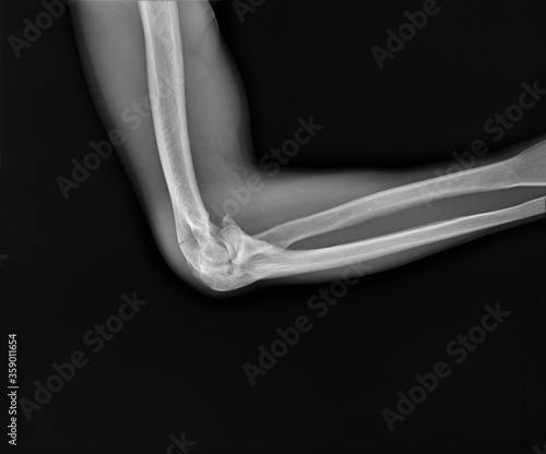 radiograph of the elbow joint of an adult with a fracture of the condyles of the humerus