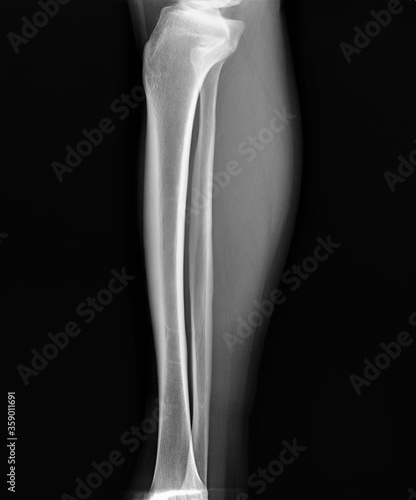 radiograph of the leg bones of an adult photo