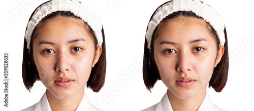 Beautiful young asian woman has freckles, dull skin, compare another side Beauty girl has nice and bright skin on face. Attractive girl get happy after get facial rejuvenation Cosmetology concept. 