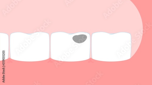 Tooth filling dental drill Vector illustration