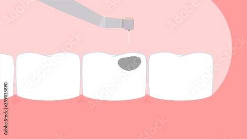Tooth filling dental drill Vector illustration