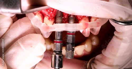 dental implantation moment through a surgical template, implantation of two front incisors