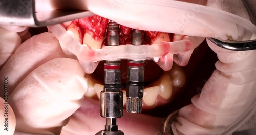 dental implant during implantation through a template for high accuracy
