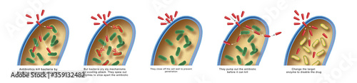 Fotografija Antimicrobial resistance or antibiotic resistance