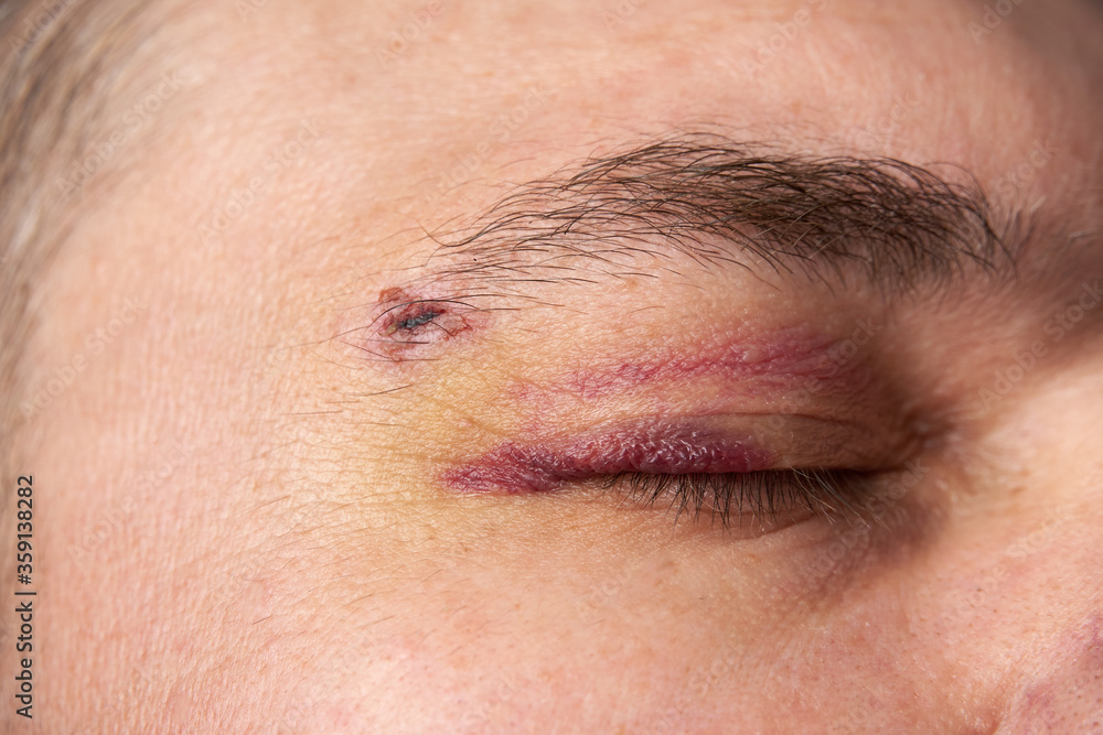 close view of a black eye, man's face with a hematoma close view of a black eye, man's face with a hematoma