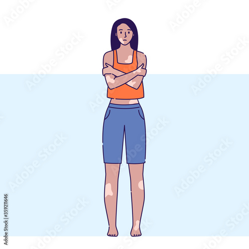 Girl with vitiligo vector illustration. Disease pigment autoimmune disease with pigment loss. Skin depigmentation and genetic illness. Isolated cartoon character on blue background