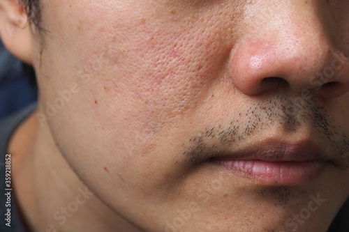 Closeup of red skin with acne black moles and pores on the face of a young Asian man