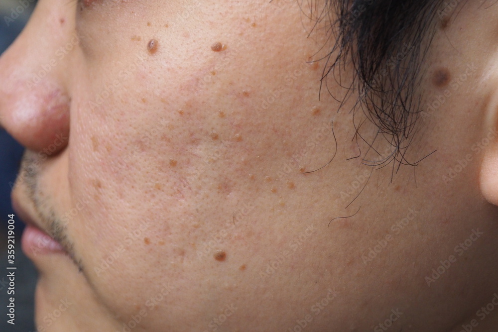Closeup of red skin with acne black moles and pores on the face of a young Asian man Closeup of red skin with acne black moles and pores on the face of a young Asian man