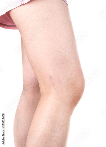 Female legs with varicose veins. Healthy lifestyle.