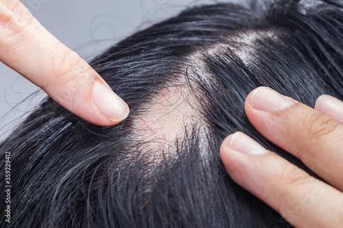 Alopecia Areata - Spot Baldness is a condition in which hair is lost from some or all areas of the body.