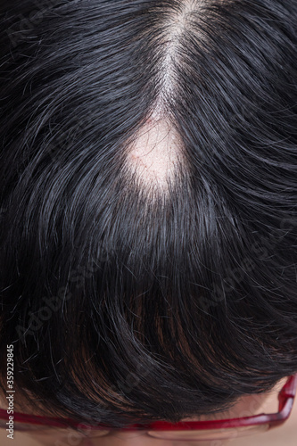Alopecia Areata - Spot Baldness is a condition in which hair is lost from some or all areas of the body.