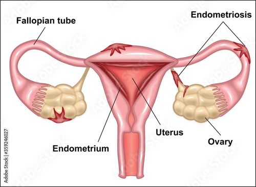 Female organs affected by endometriosis