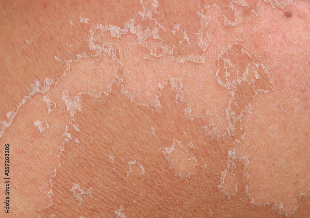 skin texture with scales of dead cells and redness after sunburn come off the body