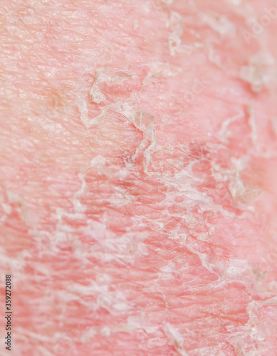 vertical background with the texture of irritated skin with cracks of dead cells and redness after sunburn and allergies on the human body