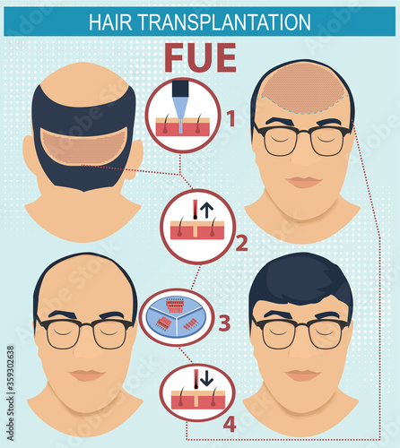 Hair transplantation surgery 3 steps infographics. Male hair loss treatment with follicular unit extraction.,