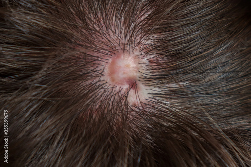 Scar from Aplasia Cutis Congenita
