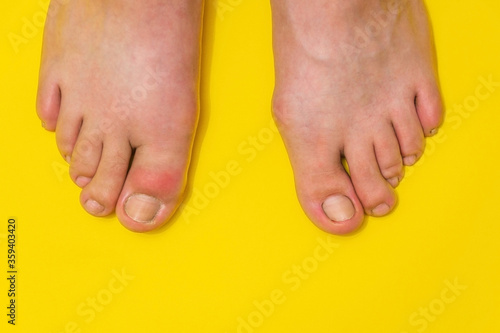 Gout or podagra on the big toe appears as redness and a unbearable pain