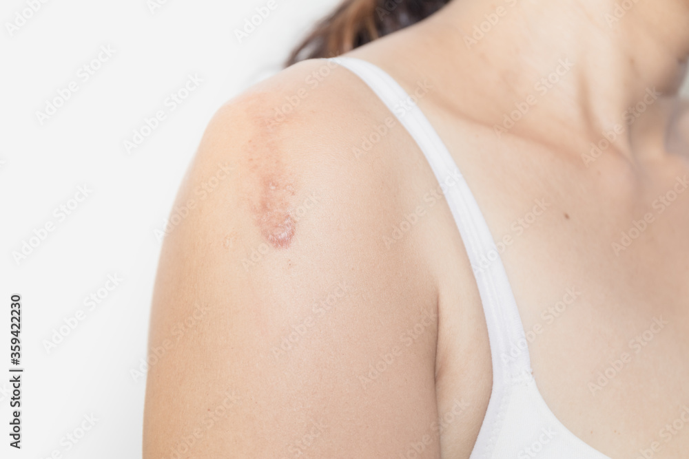 Close up a large scars from vaccination on the right arm of Asian young woman
Close up a large scars from vaccination on the right arm of Asian young woman
