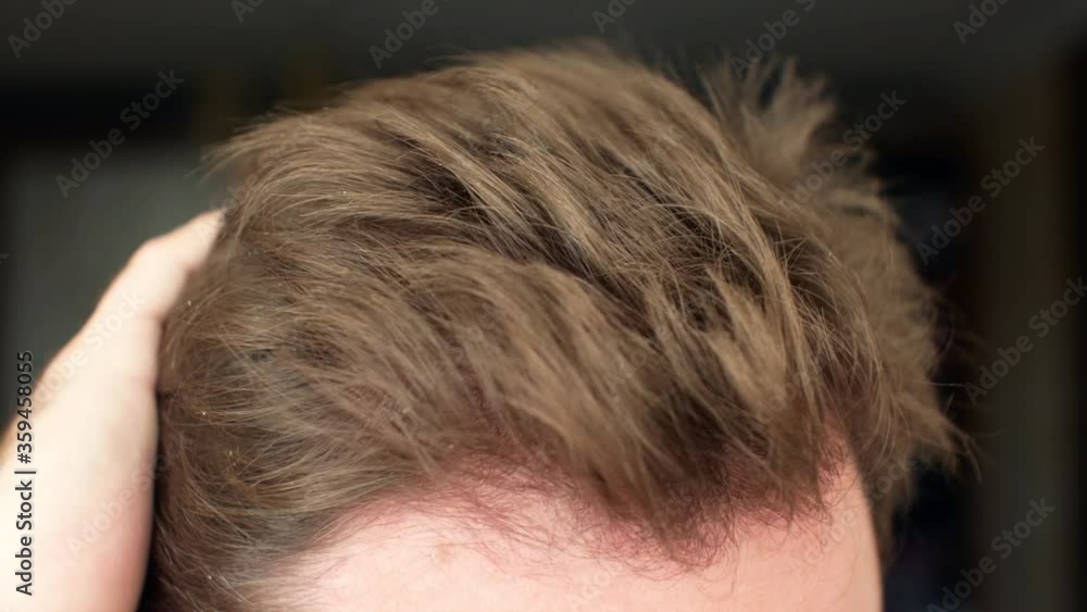 Human hair. Hair problems of a man-dermatitis dandruff hair loss Human hair. Hair problems of a man-dermatitis dandruff hair loss