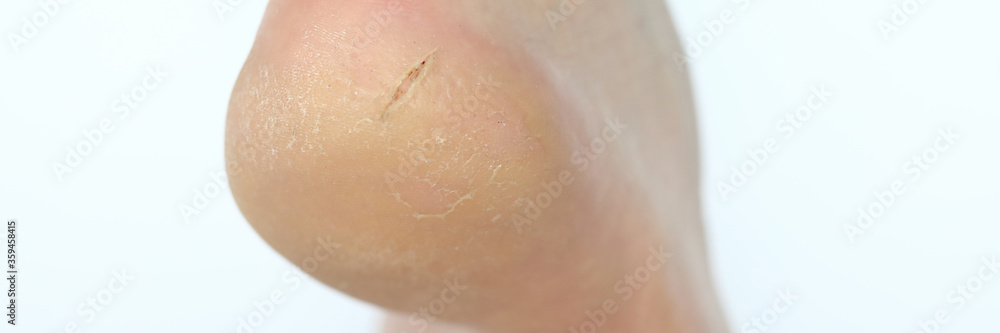 Fototapeta premium Close-up view of persons crack on heel. Dry badly cared foot. Health and dermatology problems concept. Barefoot woman or man. Part of human body. Isolated on white