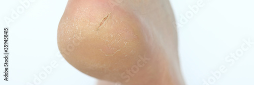 Close-up view of persons crack on heel. Dry badly cared foot. Health and dermatology problems concept. Barefoot woman or man. Part of human body. Isolated on white