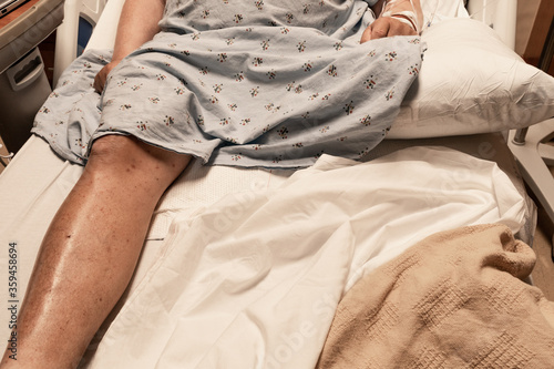 Torso and leg of a man in a hospital gown and bed, amputee missing leg, amputated limb disabled veteran, horizontal aspect