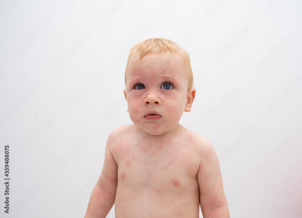 Toddler with severe allergic reaction on face and body. swollen skin Toddler with severe allergic reaction on face and body. swollen skin