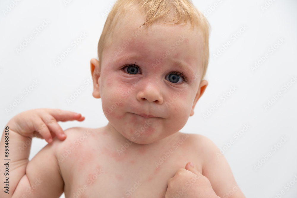 severe allergic reaction to food allergies. boy's face is swollen Stock  Photo | Adobe Stock